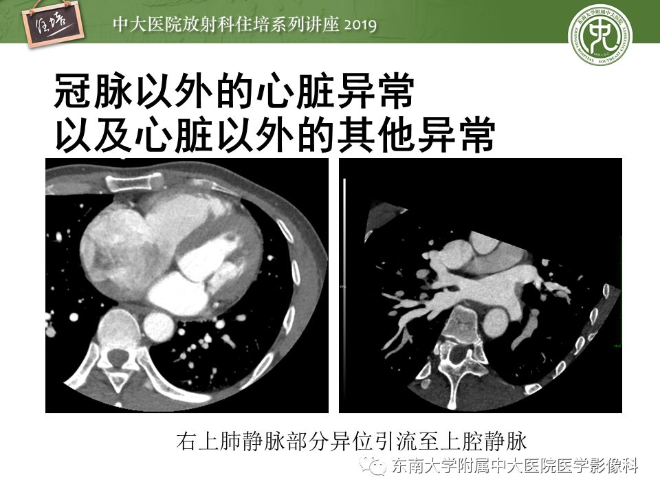 不能错过！冠状动脉CTA诊断超全教程