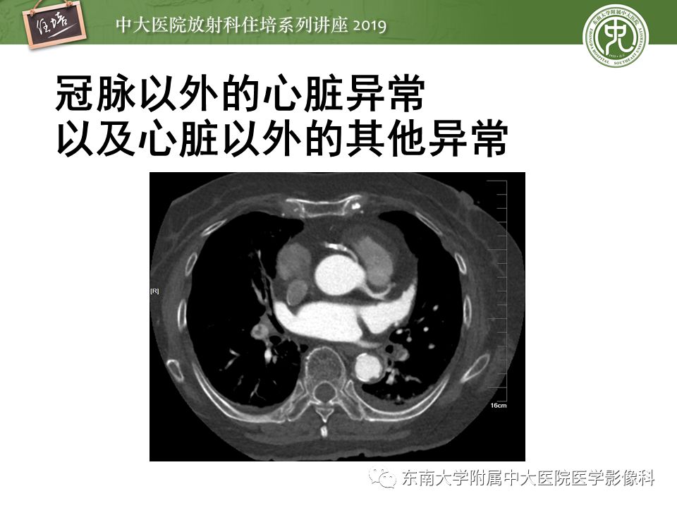 不能错过！冠状动脉CTA诊断超全教程