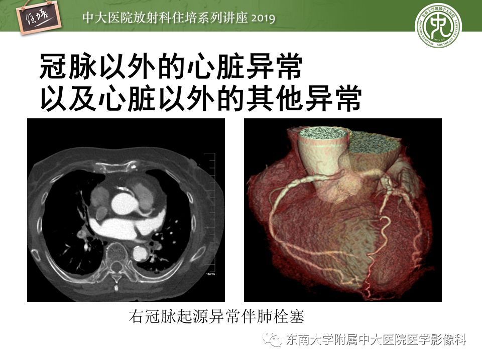 不能错过！冠状动脉CTA诊断超全教程