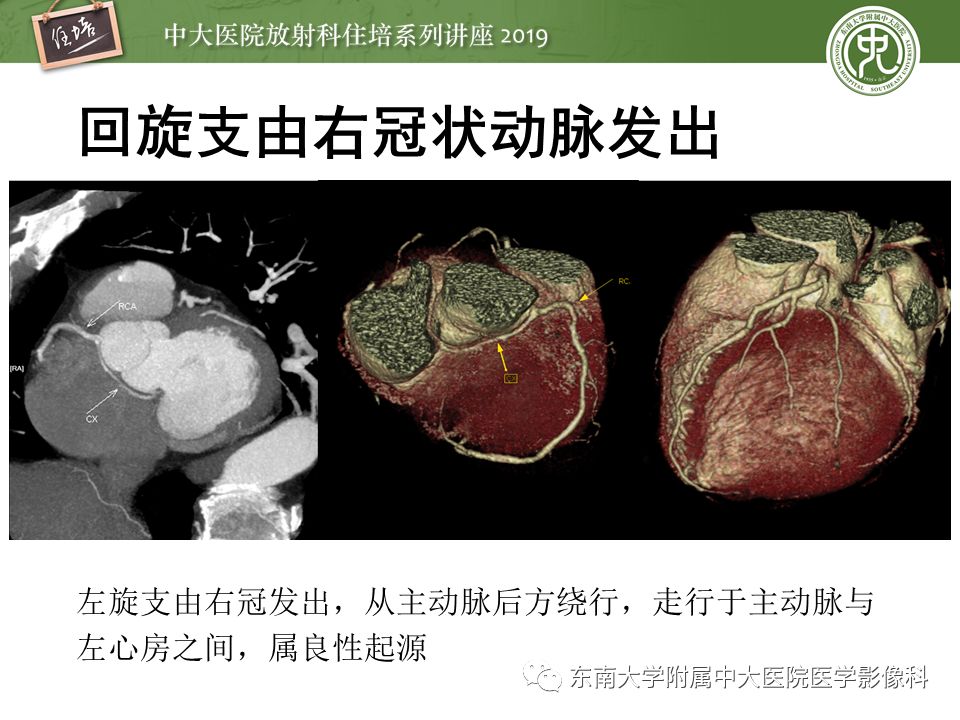 不能错过！冠状动脉CTA诊断超全教程