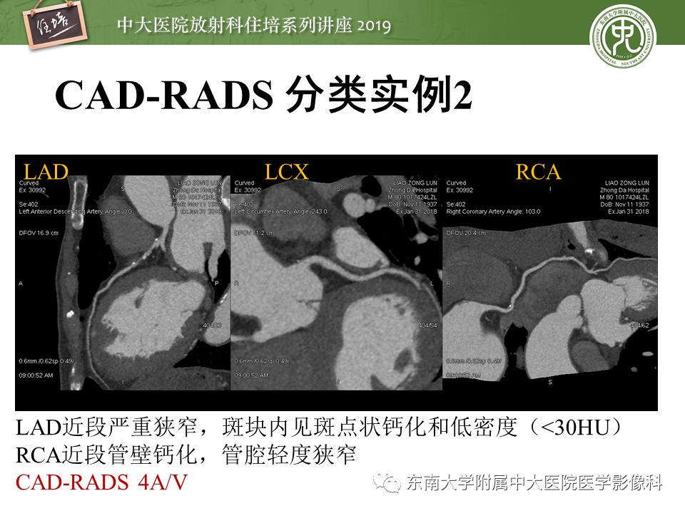 不能错过！冠状动脉CTA诊断超全教程