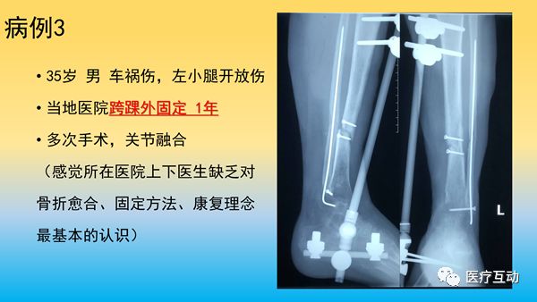 一文详解：骨折后急性骨丢失的处理策略