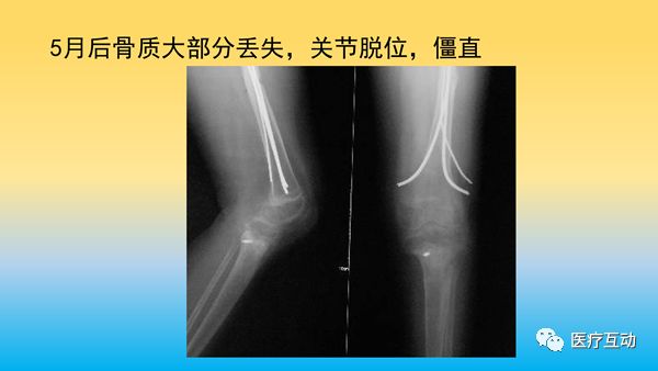 一文详解：骨折后急性骨丢失的处理策略