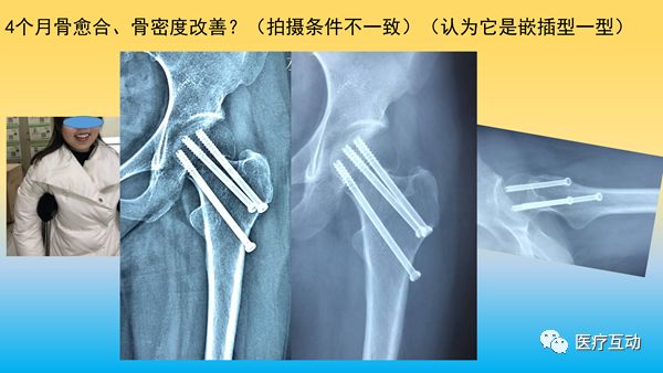 一文详解：骨折后急性骨丢失的处理策略