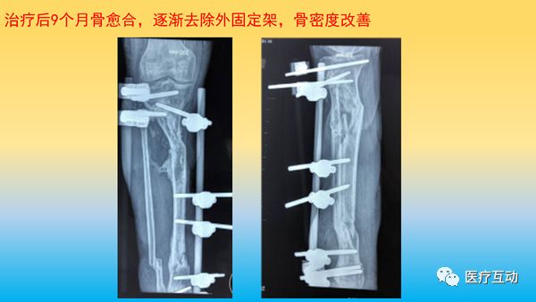 一文详解：骨折后急性骨丢失的处理策略