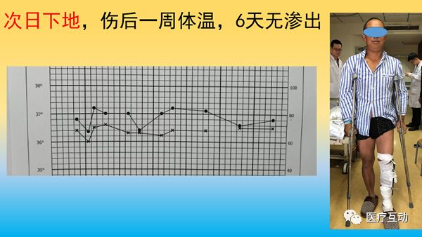 一文详解：骨折后急性骨丢失的处理策略