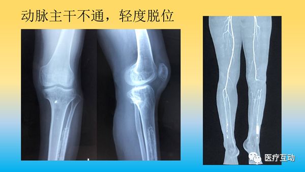 一文详解：骨折后急性骨丢失的处理策略