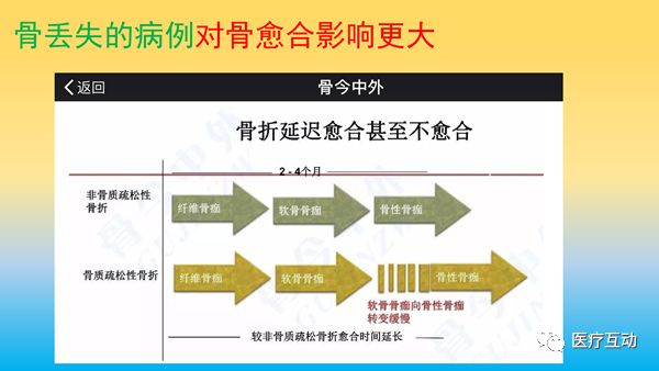 一文详解：骨折后急性骨丢失的处理策略