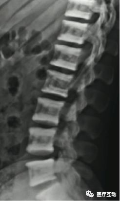 值得一看！脊柱上可能提示系统性病变的影像学改变图谱