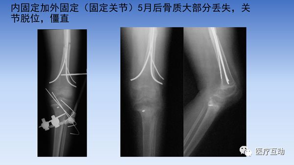 一文详解：膝关节周围骨牵引技巧