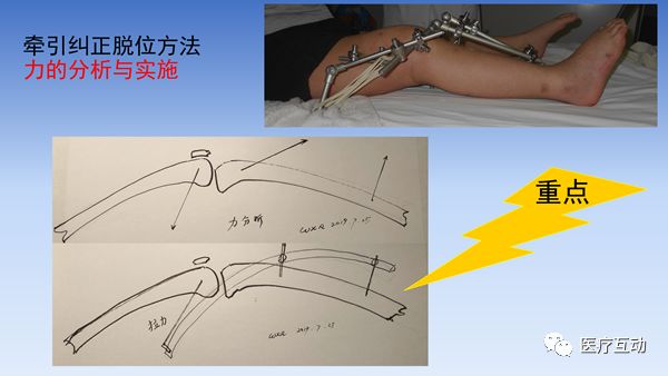 一文详解：膝关节周围骨牵引技巧