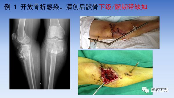 一文详解：膝关节周围骨牵引技巧