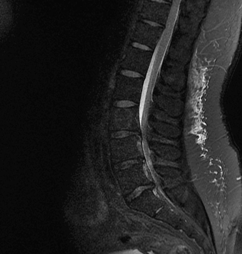 椎管狭窄的少见原因及影像学表现图谱，值得收藏！