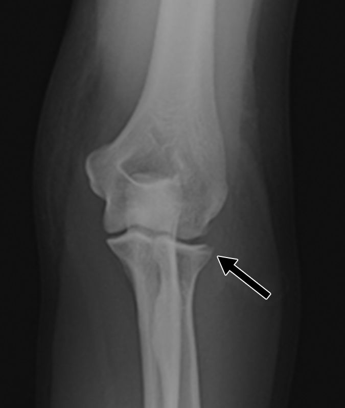需要注意！容易漏诊的上肢创伤X线片