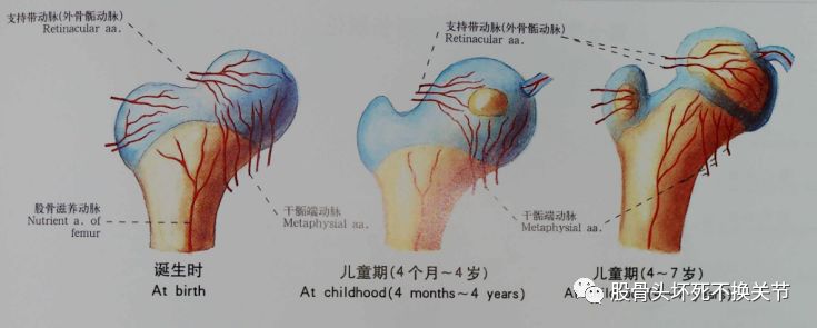 股骨头坏死原因剖析，值得一看！