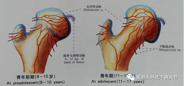 股骨头坏死原因剖析，值得一看！