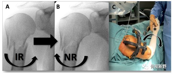 肱骨近端骨折：直型髓内钉固定技术