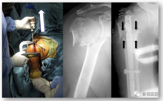 肱骨近端骨折：直型髓内钉固定技术