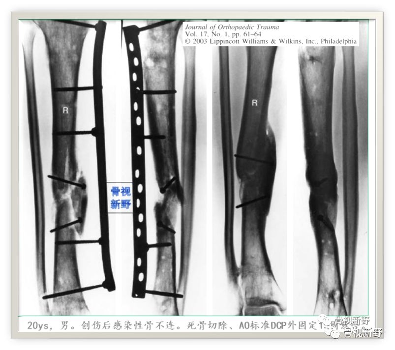 一篇掌握：锁定钢板的外固定应用技巧！