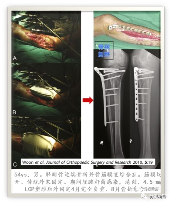 一篇掌握：锁定钢板的外固定应用技巧！