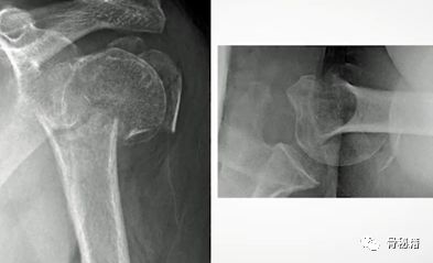 肱骨近端multilock髓内钉的介绍和复位小技巧
