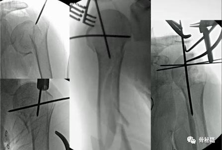 肱骨近端multilock髓内钉的介绍和复位小技巧