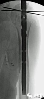 肱骨近端multilock髓内钉的介绍和复位小技巧