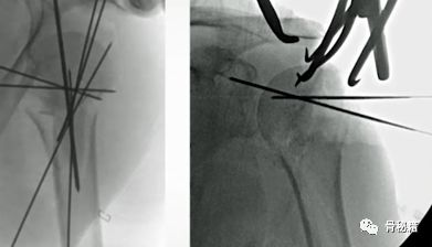 肱骨近端multilock髓内钉的介绍和复位小技巧