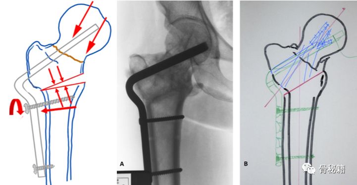 股骨近端截骨翻修的六步术前规划，你都掌握了吗？