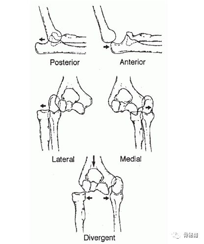 肘关节脱位与后外侧不稳的治疗策略