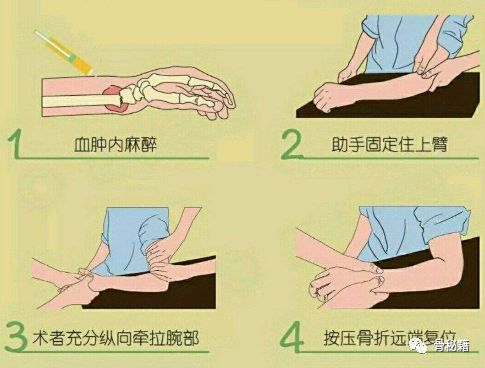 如何做好石膏固定？看看这篇！