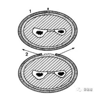 如何做好石膏固定？看看这篇！