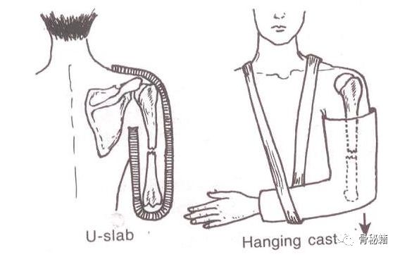 如何做好石膏固定？看看这篇！