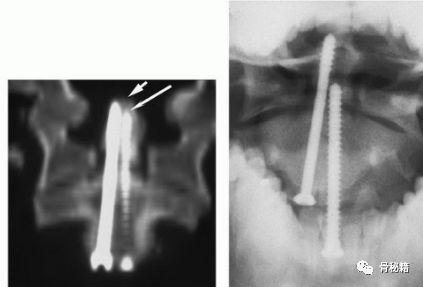 前路齿突螺钉固定齿突骨折，要点详解！
