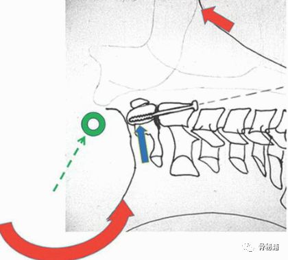 前路齿突螺钉固定齿突骨折，要点详解！