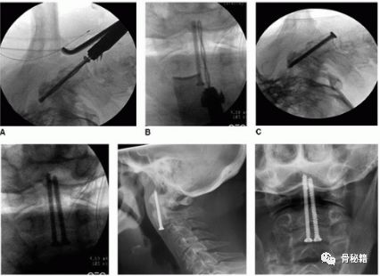 前路齿突螺钉固定齿突骨折，要点详解！