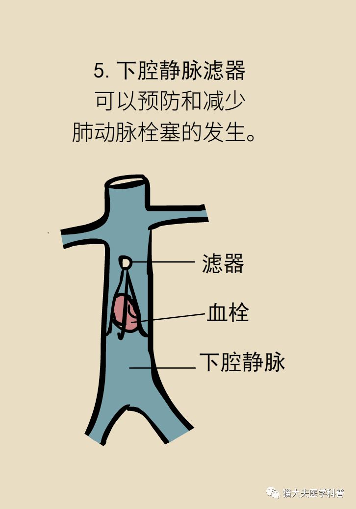 崴脚12天后肺栓塞离世，深静脉血栓几大高危因素，你中招了吗？