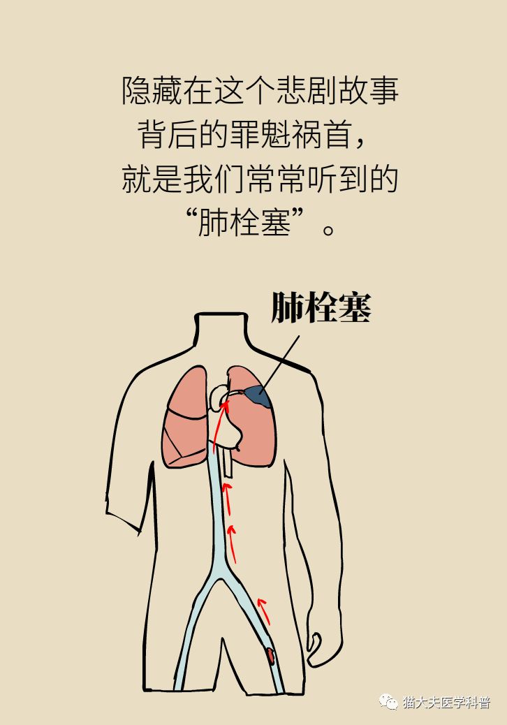 崴脚12天后肺栓塞离世，深静脉血栓几大高危因素，你中招了吗？