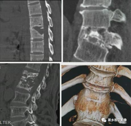 7招学会脊柱布病与结核的鉴别