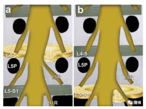 腰椎间盘摘除术技巧详解，值得一看！