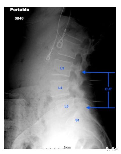 腰椎节段的术中定位技巧，值得一看！