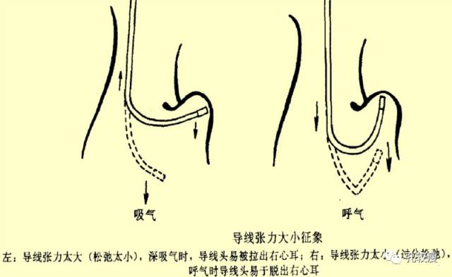 手把手教你做心脏起搏器(精美图文教学)