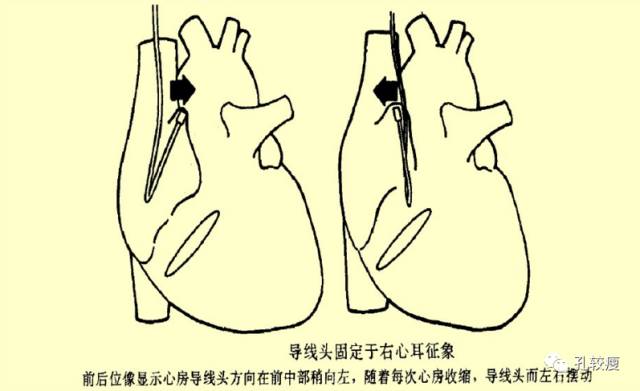 手把手教你做心脏起搏器(精美图文教学)