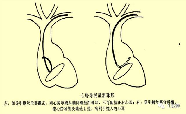 手把手教你做心脏起搏器(精美图文教学)