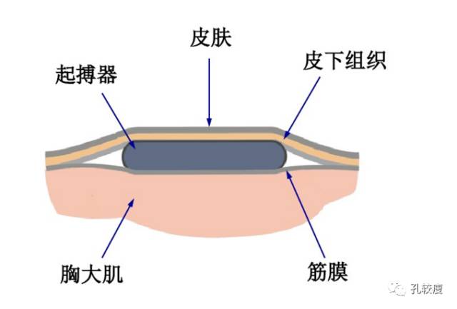 手把手教你做心脏起搏器(精美图文教学)