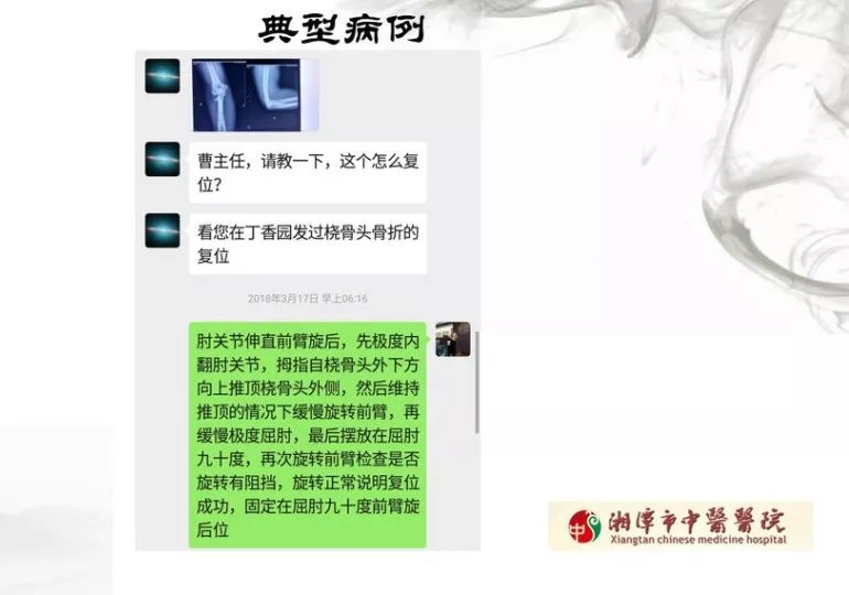 骨科医生必须掌握：桡骨颈骨折的7种治疗方法！