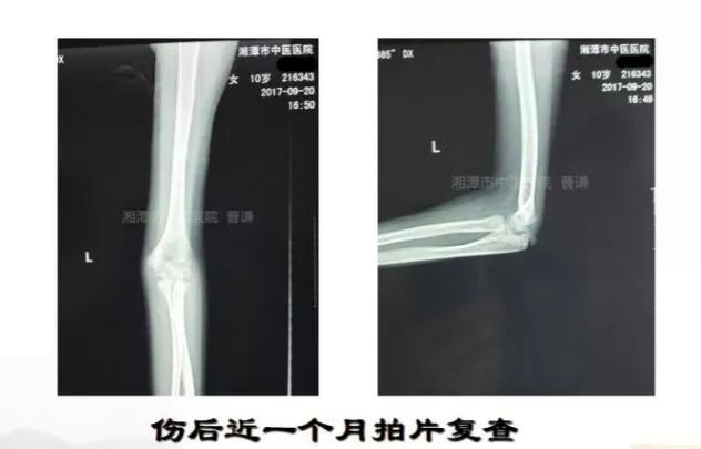 骨科医生必须掌握：桡骨颈骨折的7种治疗方法！