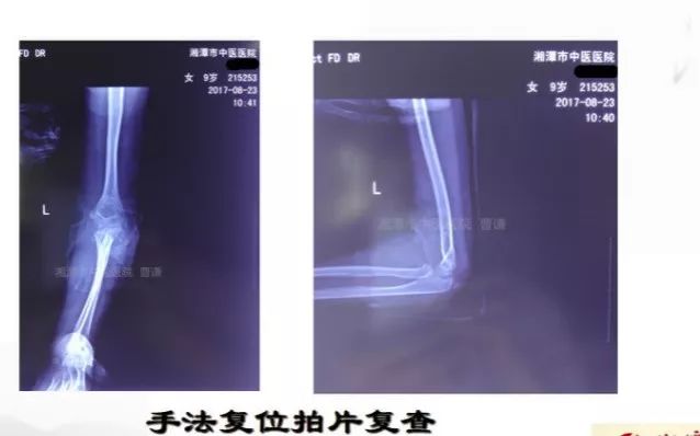 骨科医生必须掌握：桡骨颈骨折的7种治疗方法！