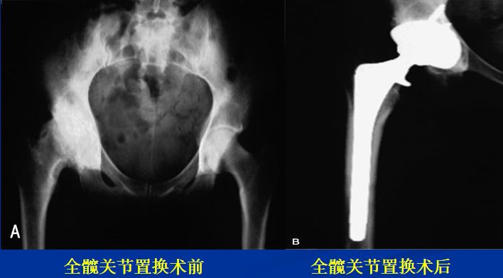 全面讲解：膝关节骨性关节炎的阶梯治疗及药物选择！