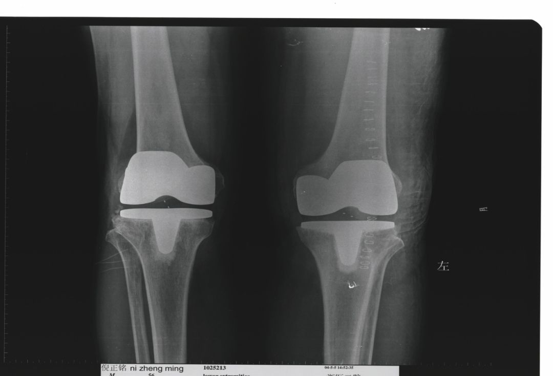 全面讲解：膝关节骨性关节炎的阶梯治疗及药物选择！